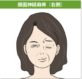 顔面神経麻痺(右側)