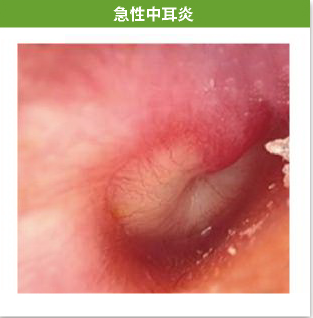 急性中耳炎