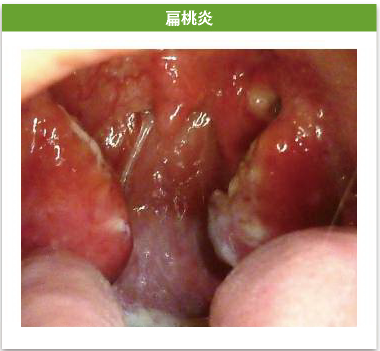 扁桃炎