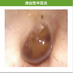 滲出性中耳炎