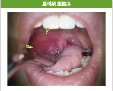 扁桃周囲膿瘍