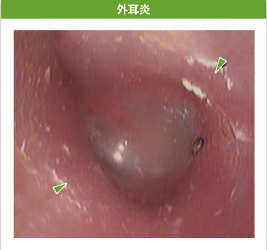 外耳炎
