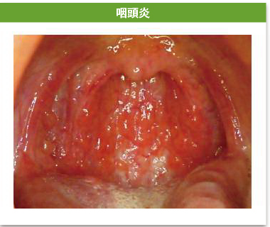 咽頭炎
