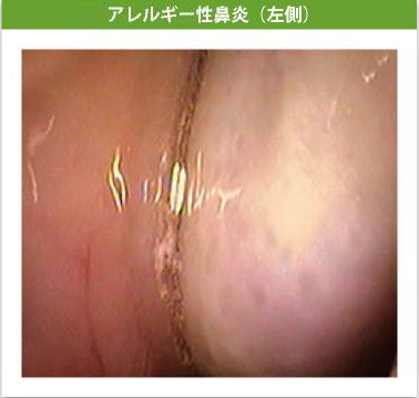 アレルギー性鼻炎（左側）