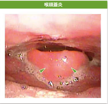 急性喉頭蓋炎