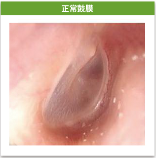 正常鼓膜